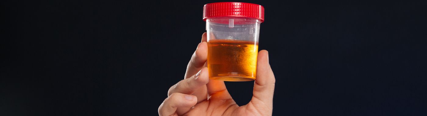 Microhematuria - Causes, Symptoms, Diagnosis, Treatment, and Prevention
