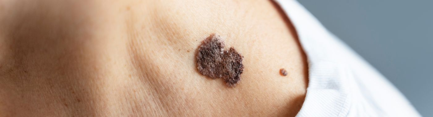 Muir Torre Syndrome - Causes, Symptoms, Diagnosis, Treatment, and Prevention