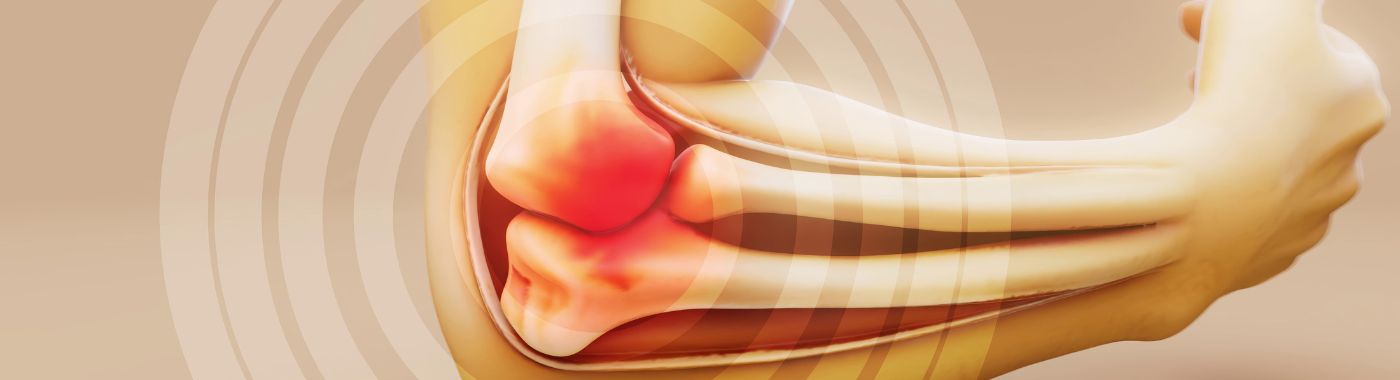 Myositis Ossificans - Causes, Symptoms, Diagnosis, Treatment, and Prevention