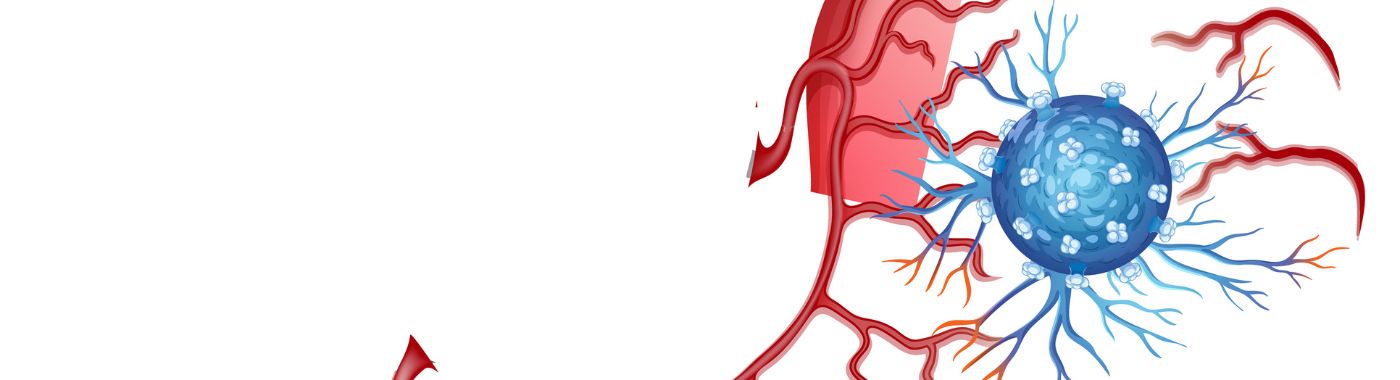 Nerve Sheath Tumors - Causes, Symptoms, Diagnosis, Treatment, and Prevention