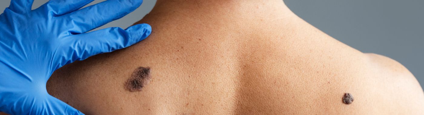 Nodular Melanoma - Causes, Symptoms, Diagnosis, Treatment, and Prevention