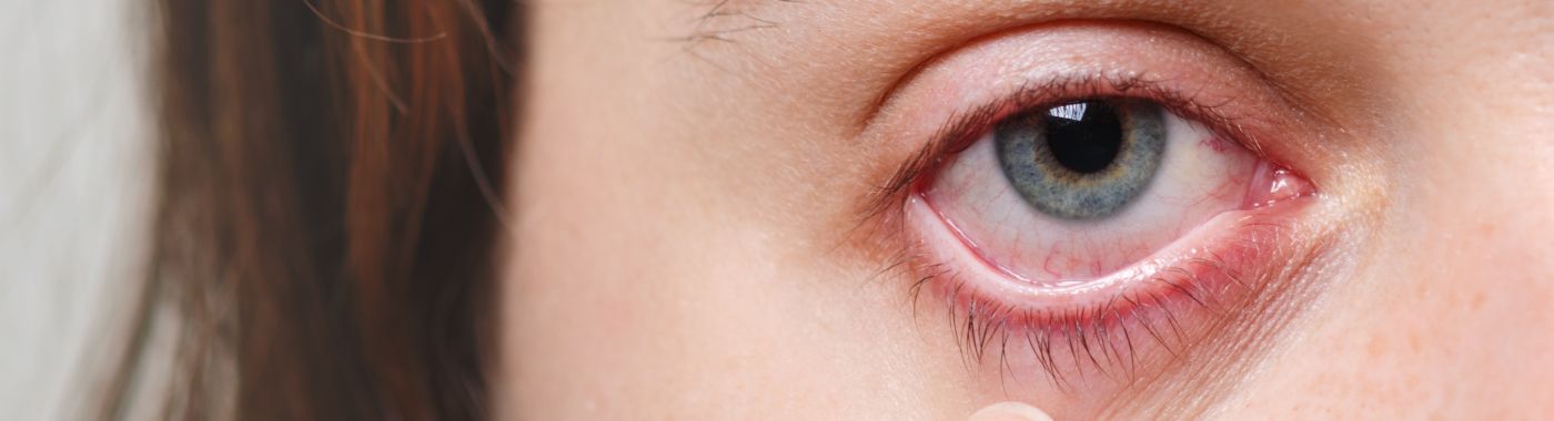 Ocular Rosacea - Causes, Symptoms, Diagnosis, Treatment, and Prevention