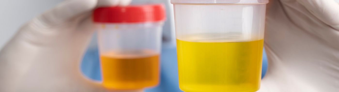 Oliguria - Causes, Symptoms, Diagnosis, Treatment, and Prevention