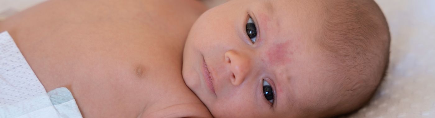 Omphalitis - Causes, Symptoms, Diagnosis, Treatment, and Prevention