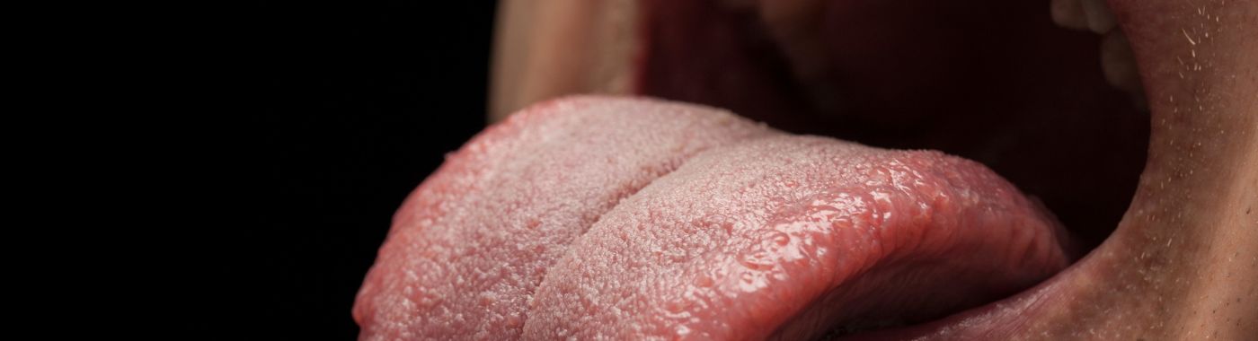 Oral Lichen Planus - Causes, Symptoms, Diagnosis, Treatment, and PreventionOral Lichen Planus - Causes, Symptoms, Diagnosis, Treatment, and Prevention