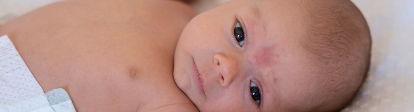 Phace Syndrome - Causes, Symptoms, Diagnosis, Treatment, and Prevention