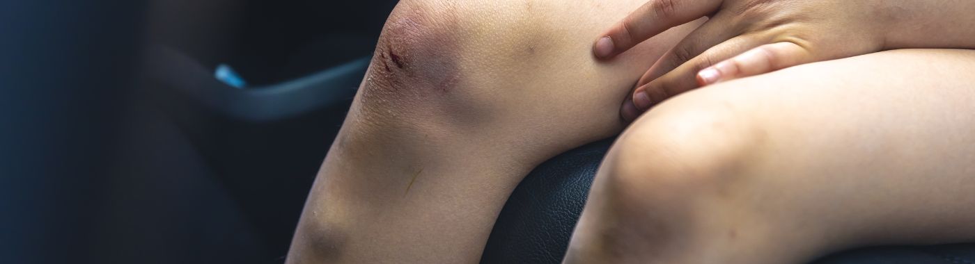 Phlegmasia Cerulea Dolens - Causes, Symptoms, Diagnosis, Treatment, and Prevention