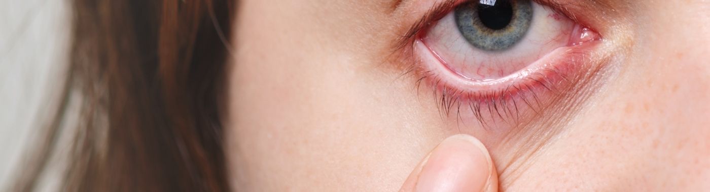 Pinguecula - Causes, Symptoms, Diagnosis, Treatment, and Prevention