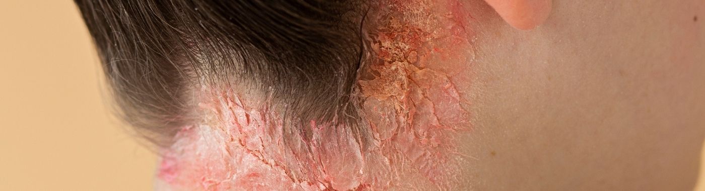 Pityrosporum Folliculitis - Causes, Symptoms, Diagnosis, Treatment, and Prevention