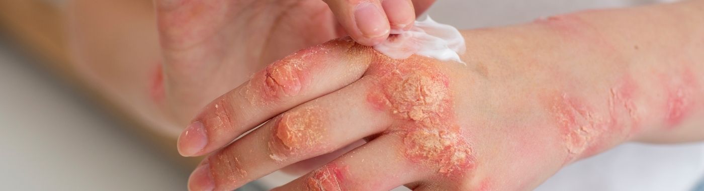 Plaque Psoriasis - Causes, Symptoms, Diagnosis, Treatment, and Prevention