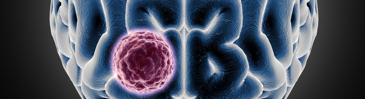 Porencephaly - Causes, Symptoms, Diagnosis, Treatment, and Prevention