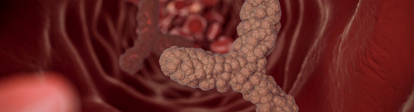 Portal Vein Thrombosis - Causes, Symptoms, Diagnosis, Treatment, and Prevention