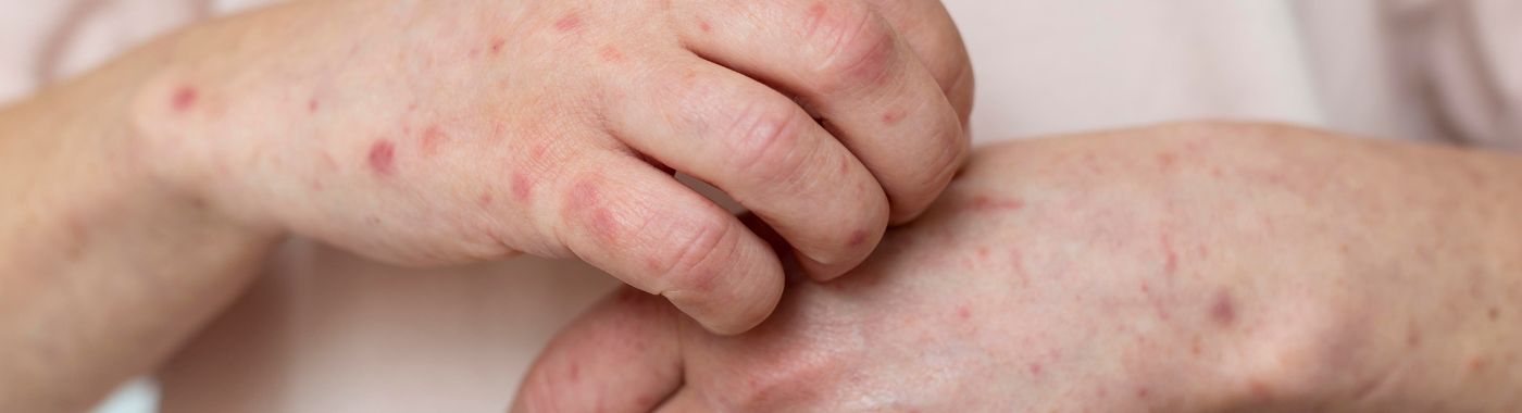 Prurigo Nodularis - Causes, Symptoms, Diagnosis, Treatment, and Prevention