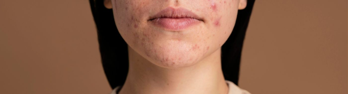 Psoriasis On The Face - Causes, Symptoms, Diagnosis, Treatment, and Prevention