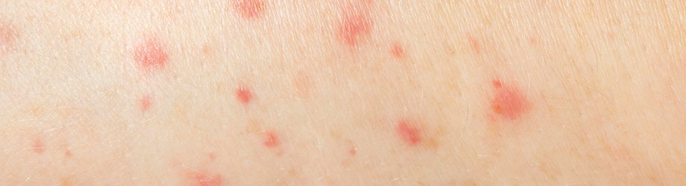 Pustular Psoriasis - Causes, Symptoms, Diagnosis, Treatment, and Prevention