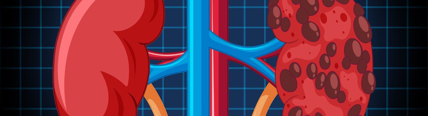 Renal Oncocytoma - Causes, Symptoms, Diagnosis, Treatment, and Prevention