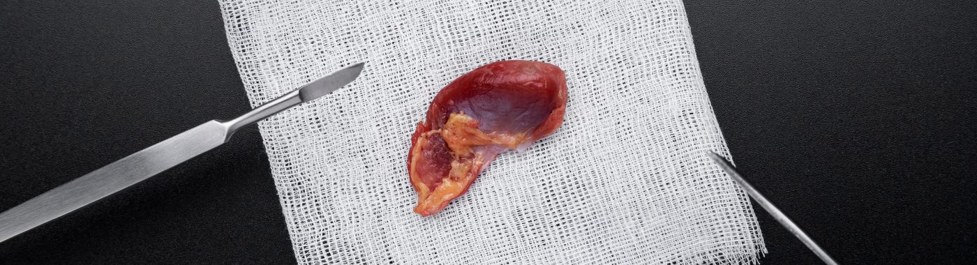 Renal Papillary Necrosis - Causes, Symptoms, Diagnosis, Treatment, and Prevention