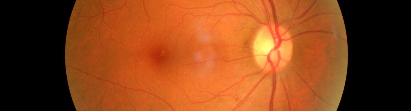 Retinoschisis - Causes, Symptoms, Diagnosis, Treatment, and Prevention