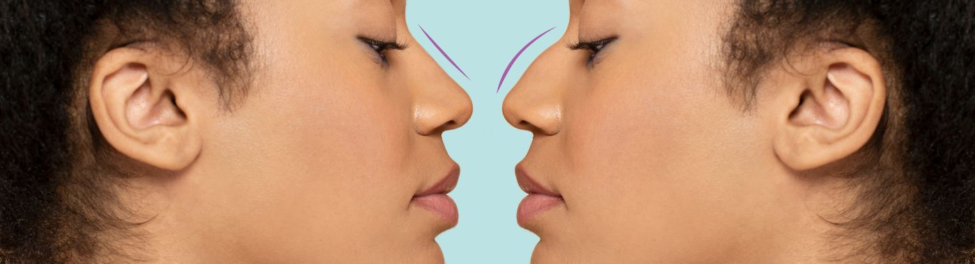 Saddle Nose - Causes, Symptoms, Diagnosis, Treatment, and Prevention