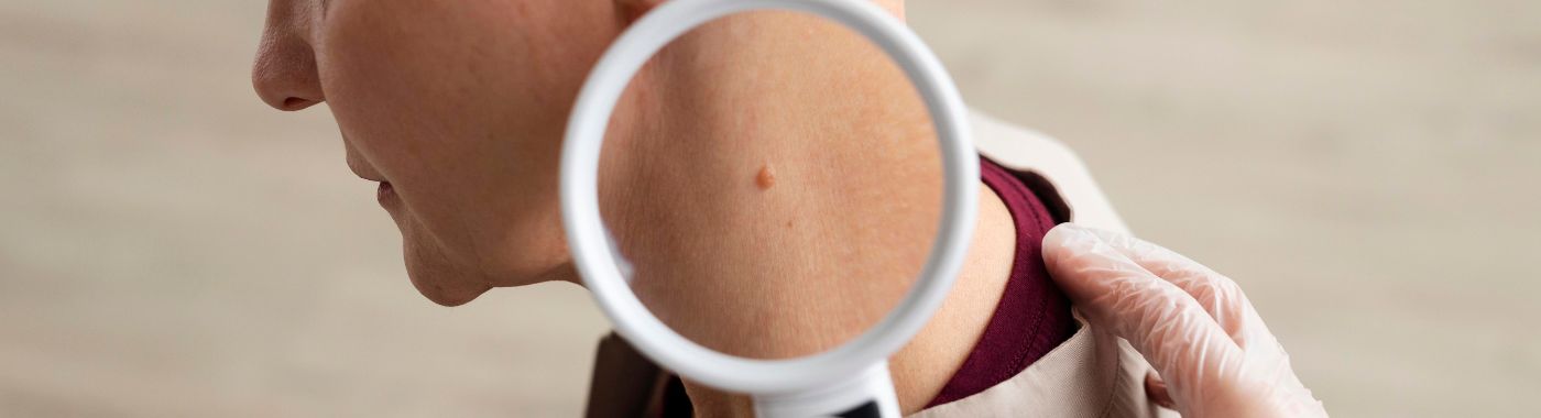 Sebaceous Cysts - Causes, Symptoms, Diagnosis, Treatment, and Prevention