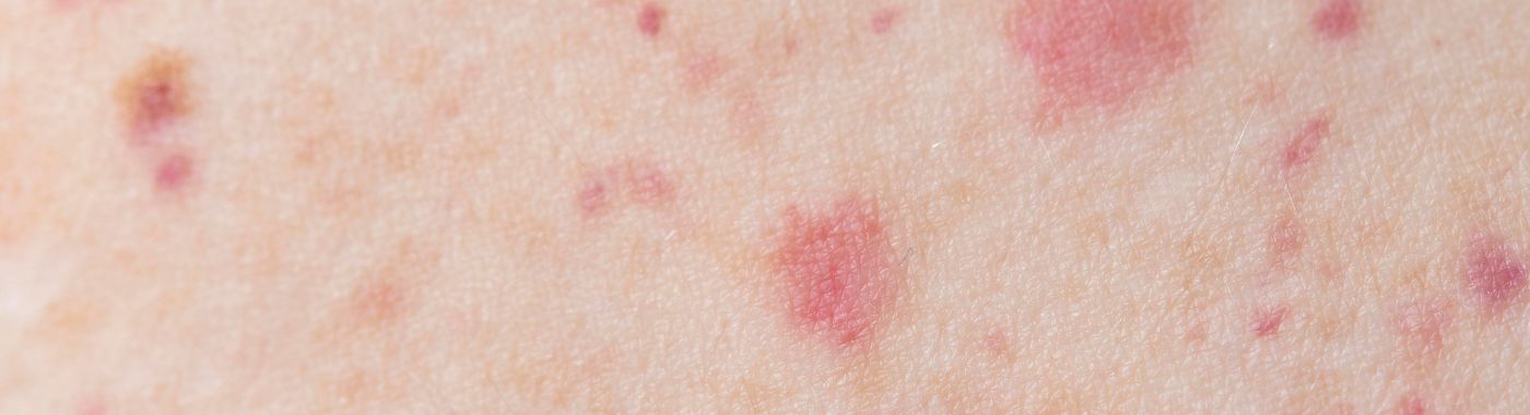 Sézary Syndrome - Early Signs, Risk Factors, Diagnosis, and Treatment Explained