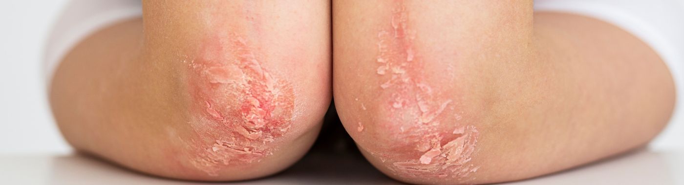 Skin Fungus - Causes, Symptoms, Diagnosis, Treatment, and Prevention