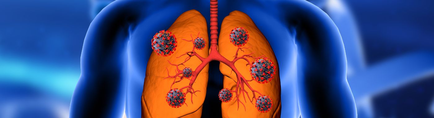 Solitary Fibrous Tumors - Causes, Symptoms, Diagnosis, Treatment, and Prevention