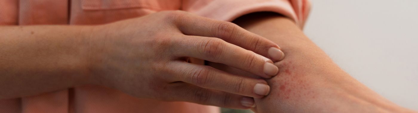 Spider Angioma - Causes, Symptoms, Diagnosis, Treatment, and Prevention