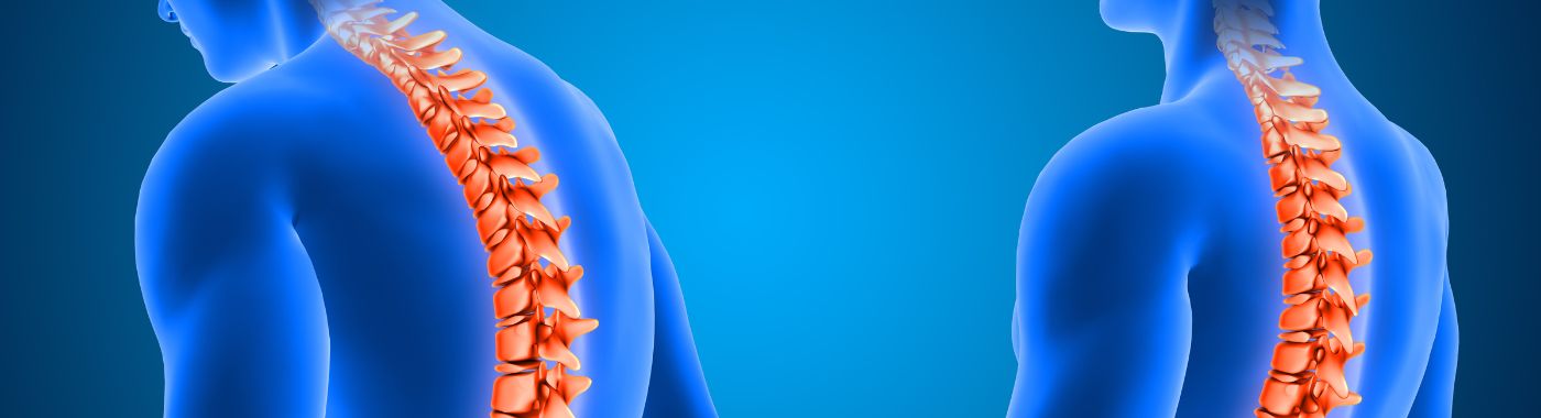 Spondylolysis - Causes, Symptoms, Diagnosis, Treatment, and Prevention