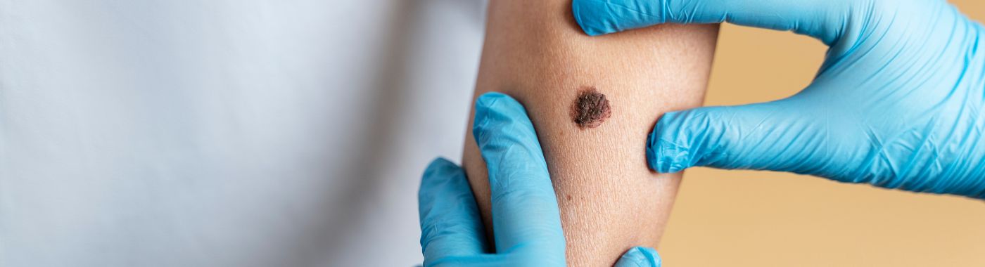 Strawberry Hemangiomas - Causes, Symptoms, Diagnosis, Treatment, and Prevention