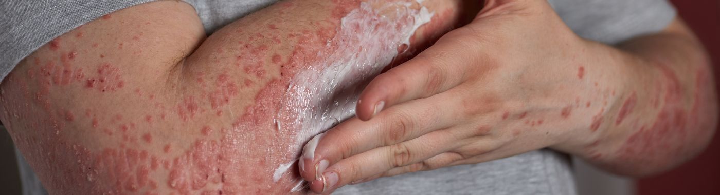 Subacute Cutaneous Lupus - Causes, Symptoms, Diagnosis, Treatment, and Prevention