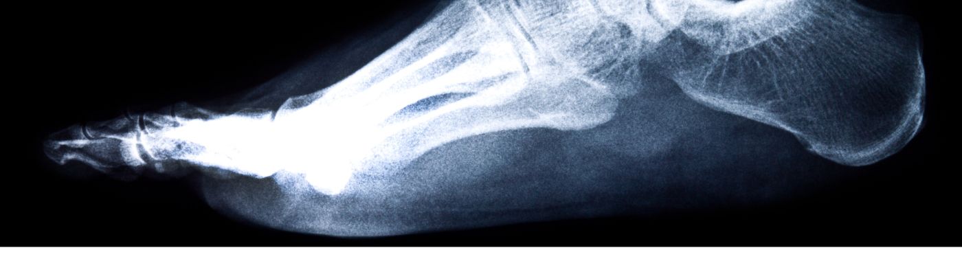 Talus Fracture - Causes, Symptoms, Diagnosis, Treatment, and Prevention