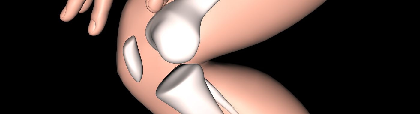 Tenosynovial Giant Cell Tumor - Causes, Symptoms, Diagnosis, Treatment, and Prevention