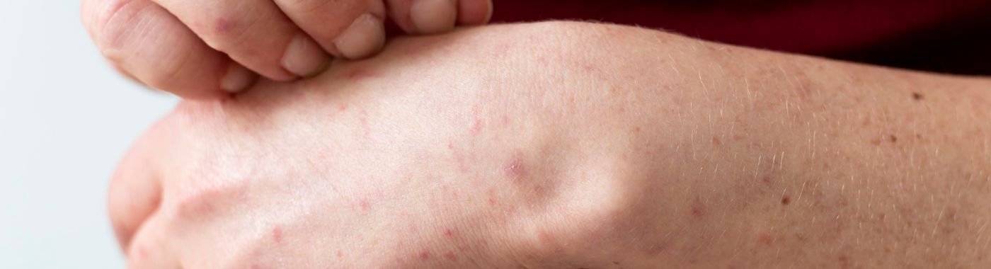 Tinea Manuum - Causes, Symptoms, Diagnosis, Treatment, and Prevention