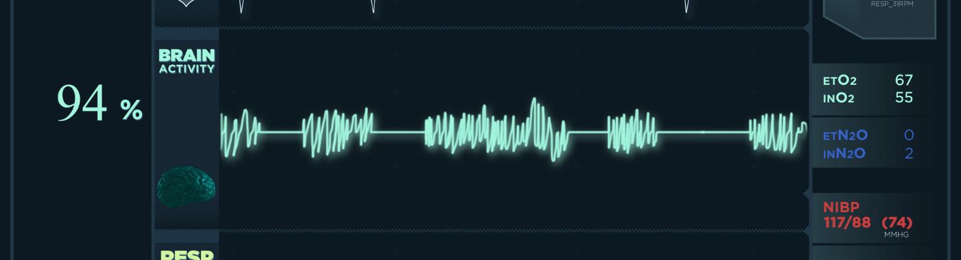 Torsades De Pointes - Causes, Symptoms, Diagnosis, Treatment, and Prevention