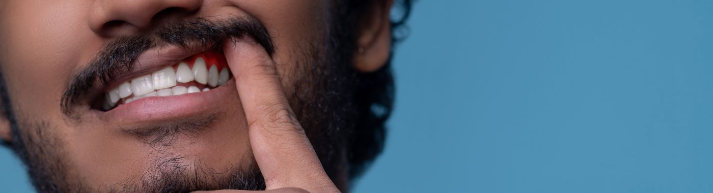 Trench Mouth - Causes, Symptoms, Diagnosis, Treatment, and Prevention