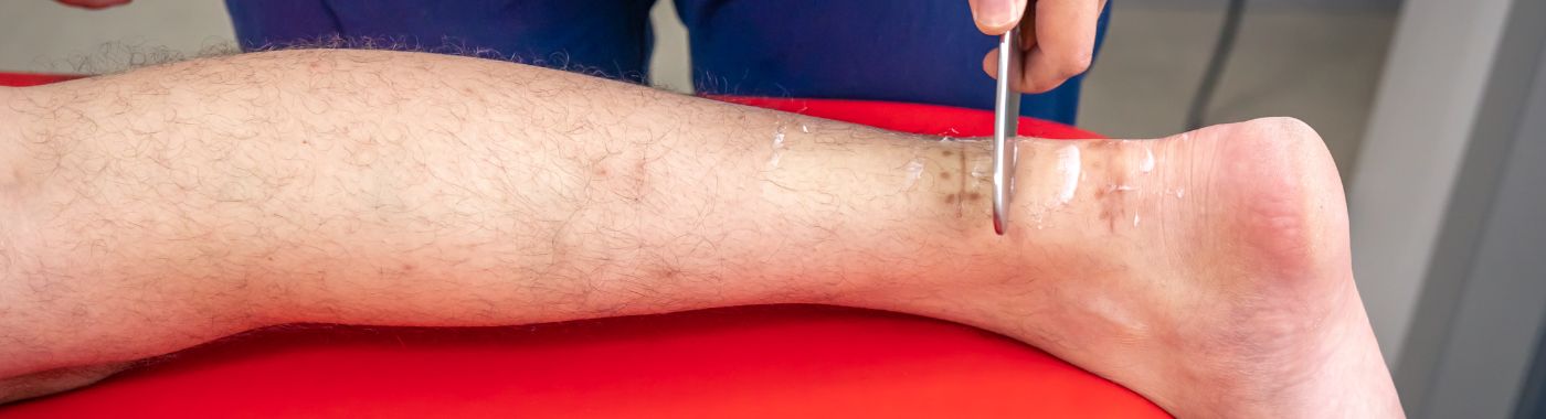 Venous Thromboembolism - Causes, Symptoms, Diagnosis, Treatment, and Prevention