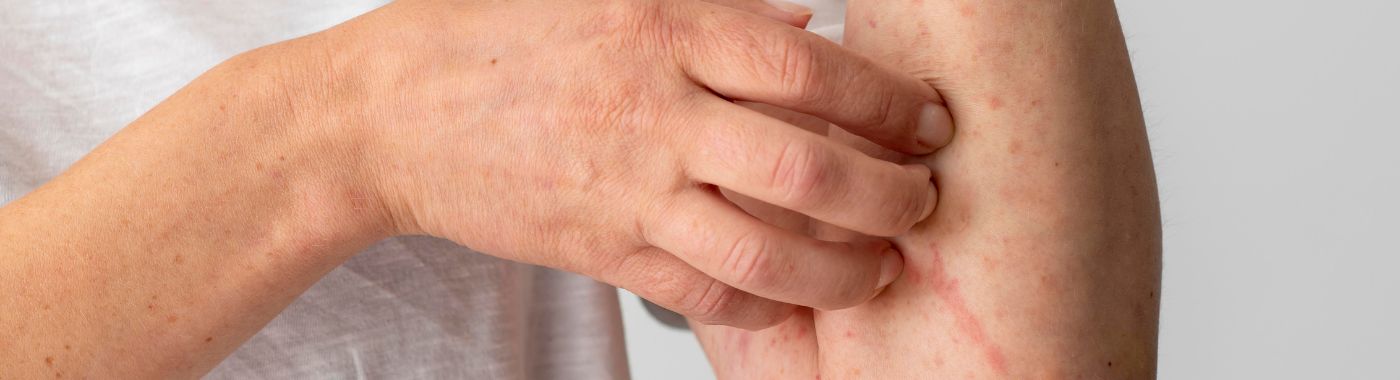 Viral Exanthem Rash - Causes, Symptoms, Diagnosis, Treatment, and Prevention