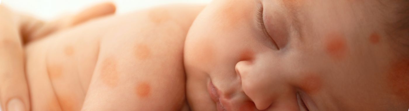 Blueberry muffin rash