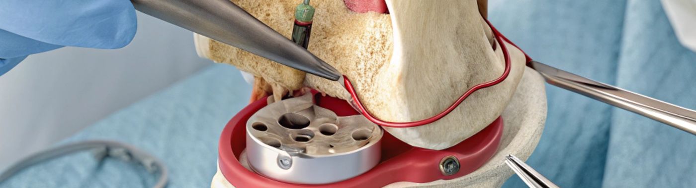 Ceramic Total Knee Replacement - Procedures, Preparation, Cost, and Recovery