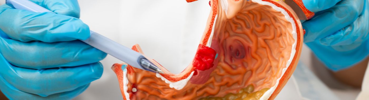 Esophagectomy - Procedures, Preparation, Cost, and Recovery