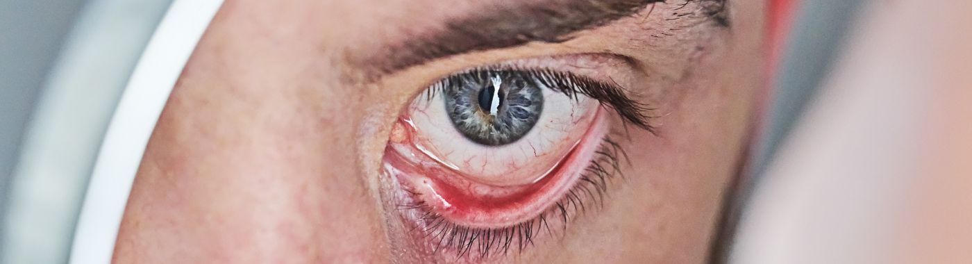 eye-intraocular-pressure