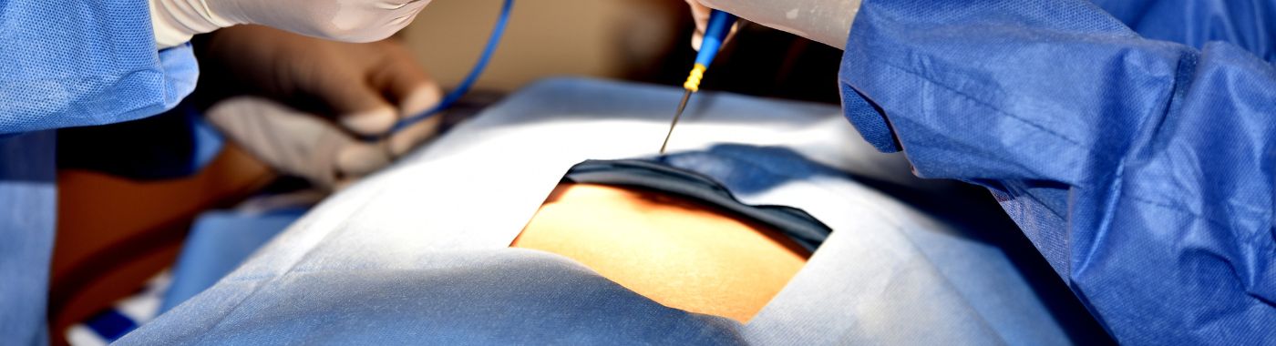 General Laparoscopic Surgery - Types, Procedure, Cost in India, Risks, Recovery and benefits