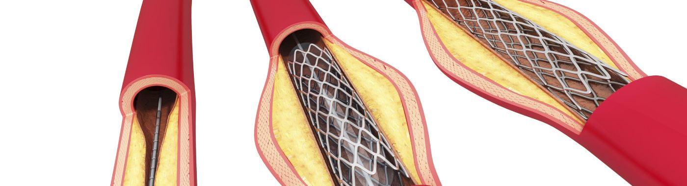 Inferior Vena Cava (IVC) - Procedures, Preparation, Cost, and Recovery