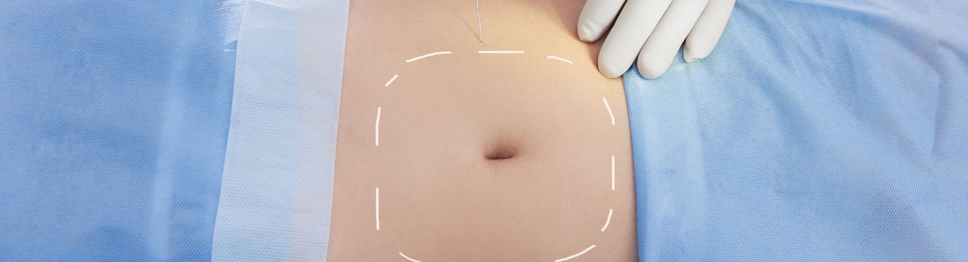 Liposuction - Procedures, Preparation, Cost, and Recovery