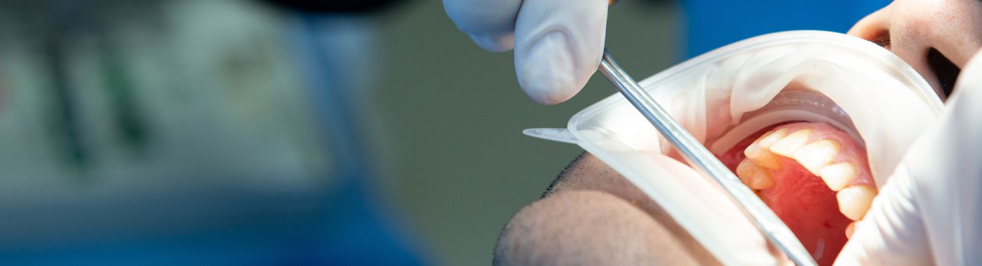 Oral Cancer Surgery (Mandibulectomy)- Procedure, Cost in India, Risks, Recovery and benefits