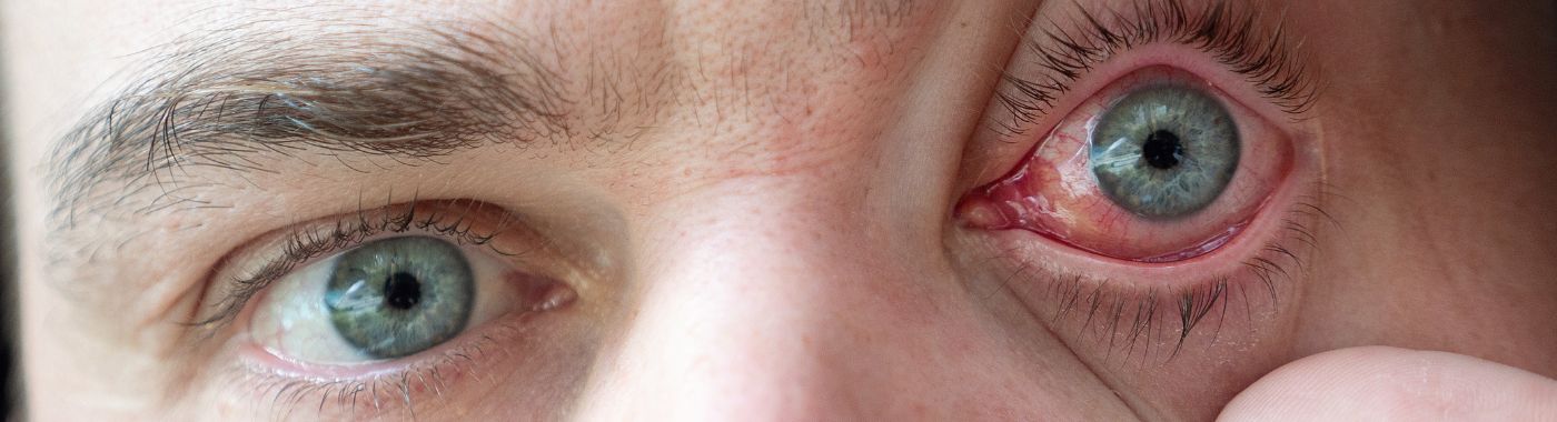 Orbital Decompression- Procedure, Cost in India, Risks, Recovery and benefits