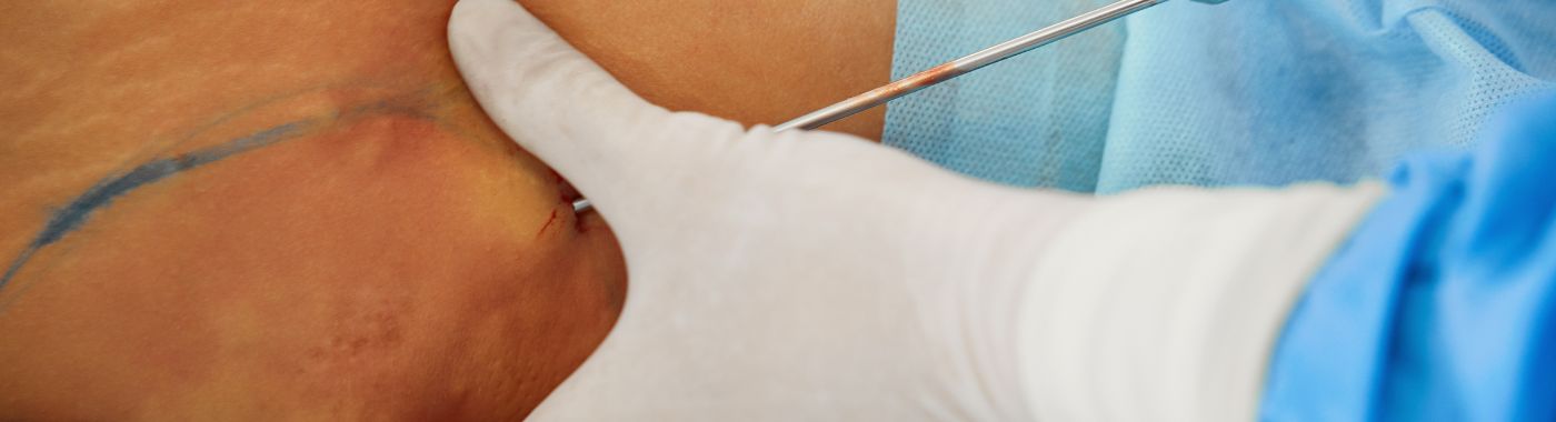 Paracentesis - Procedures, Preparation, Cost, and Recovery