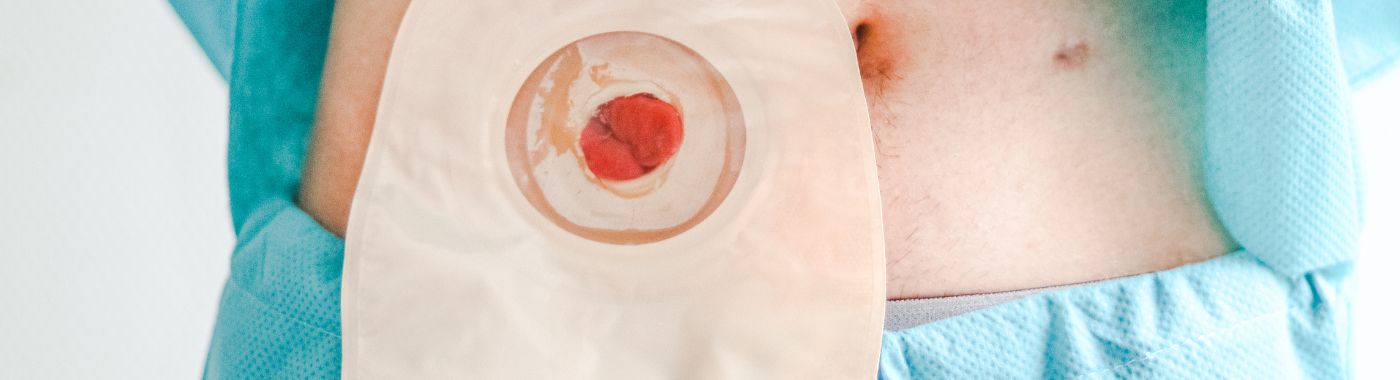 Pediatric Colostomy/Ileostomy- Types, Procedure, Cost in India, Risks, Recovery and benefits