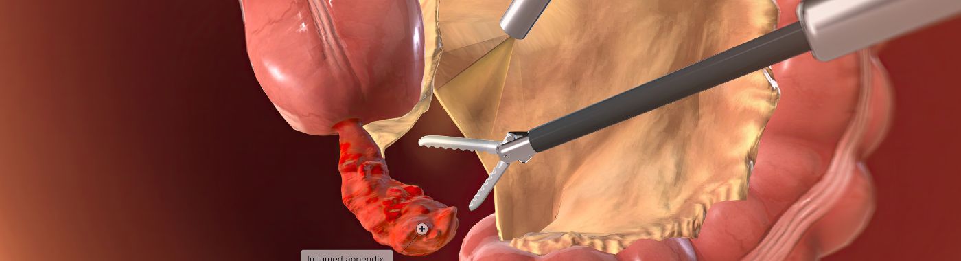 Polypectomy - Procedures, Preparation, Cost, and Recovery